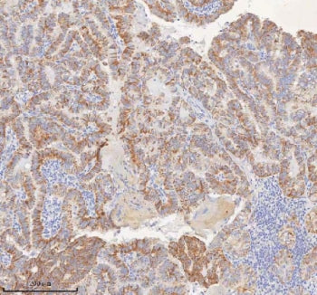 IHC staining of FFPE human thyroid papillary carcinoma tissue with MINDY4 antibody. HIER: boil tissu