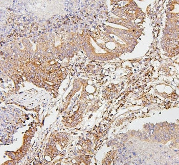 IHC staining of FFPE human intestinal cancer with SDHB antibody. HIER: boil tissue sections in pH6, 