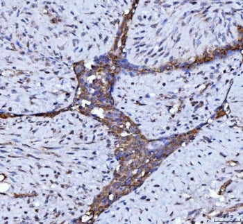IHC staining of FFPE human breast cancer tissue with BECN1 antibody. HIER: boil tissue sections in p