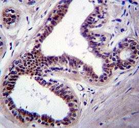 JNK1 antibody immunohsitochemistry analysis in formalin fixed and paraffin embedded human breast tis