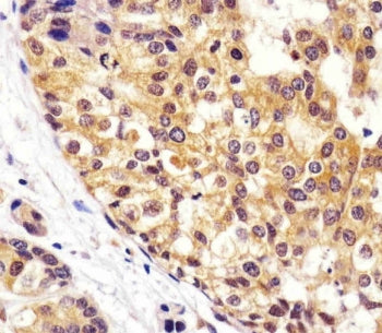 IHC testing of FFPE human breast cancer tissue with VCP antibody. HIER: steam section in pH6 citrate