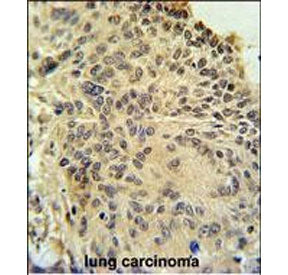 IHC staining of FFPE human lung carcinoma tissue with RSPO2 antibody. HIER: steam section in pH6 cit