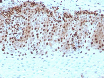 IHC staining of FFPE human cervical carcinoma with recombinant c-Myc antibody. HIER: boil tissue sec