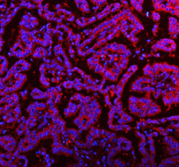Immunofluorescent staining of FFPE human lung cancer tissue with RNF25 antibody (red) and DAPI nucle