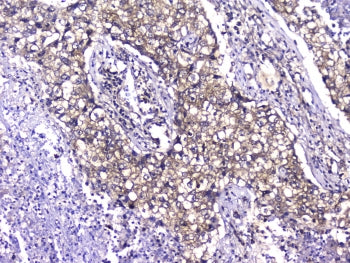 IHC testing of FFPE human lung cancer with TCP1 alpha antibody at 2ug/ml. HIER: boil tissue sections