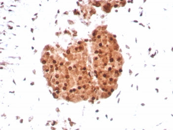IHC staining of FFPE human sarcoma tissue with INI-1 antibody (clone SMARCB1/8851R) HIER: boil tissu