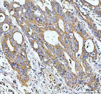 IHC staining of FFPE human colorectal cancer tissue with GCLC antibody. HIER: boil tissue sections i