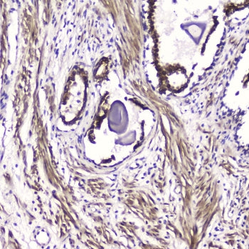 IHC testing of FFPE human prostate cancer with ATF4 antibody at 2ug/ml. HIER: boil tissue sections i