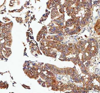 IHC staining of FFPE human rectum adenocarcinoma tissue with IDI1 antibody. HIER: boil tissue sectio