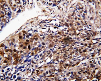IHC staining of FFPE human lung cancer tissue with DDT antibody. HIER: boil tissue sections in pH6, 