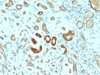 IHC staining of FFPE human renal cell carcinoma with STAT3 antibody (clone STAT3/2409). HIER: boil t