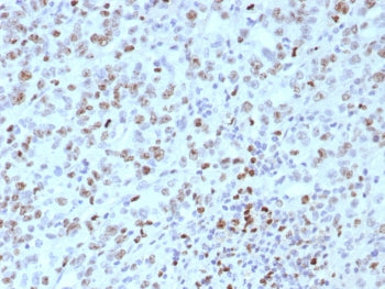 IHC staining of FFPE human Lynch disease colon tissue with MLH1 antibody (clone rMLH1/8630). HIER: b