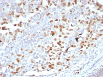 IHC staining of FFPE human melanoma tissue with OIP-4 antibody (clone PRAME/6928R). HIER: boil tissu