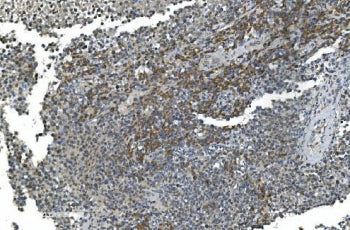 IHC staining of FFPE human testicular cancer with TIMM8A antibody. HIER: boil tissue sections in pH8