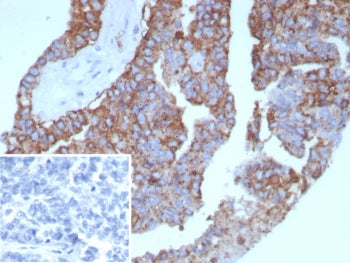 IHC staining of FFPE human ovarian cancer tissue with Pan-HLA antibody (clone rHLA-Pan/8847). Inset: