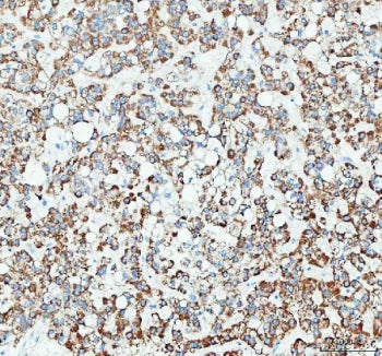 IHC staining of FFPE human liver cancer tissue with RAB3IP antibody. HIER: boil tissue sections in p
