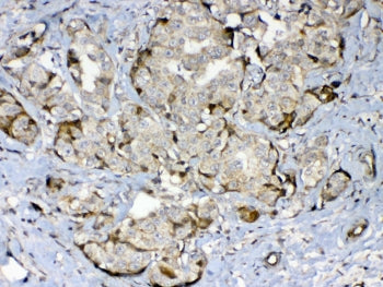 IHC testing of FFPE human breast cancer tissue with GAD65 antibody at 1ug/ml. Required HIER: steam s