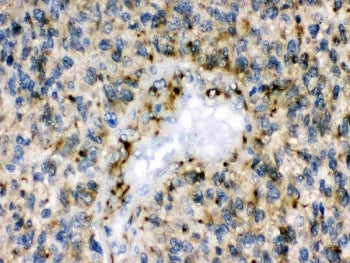 IHC testing of FFPE human glioma tissue with EPHB1 antibody. HIER: Boil the paraffin sections in pH 