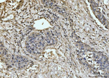 IHC staining of FFPE human liver cancer tissue with EXOSC8 antibody. HIER: boil tissue sections in p