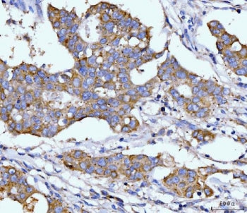IHC staining of FFPE human breast cancer tissue with Dihydroorotate dehydrogenase antibody. HIER: bo