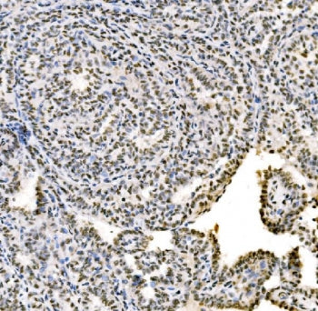 IHC staining of FFPE human Hashimoto's thyroiditis tissue with SSB antibody. HIER: boil tissue secti