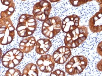 IHC testing of FFPE human colon carcinoma with recombinant EpCAM antibody (clone rMOC-31). Required 