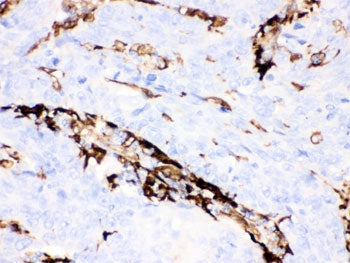 IHC testing of FFPE human lung cancer tissue with Gelsolin antibody. HIER: steamed with pH6 citrate 