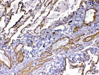 IHC testing of FFPE human lung cancer tissue with VEGF Receptor 3 antibody at 1ug/ml. Required HIER:
