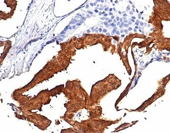 IHC staining of FFPE human prostate tissue with IDH1-R132H mutation with Isocitrate Dehydrogenase R1