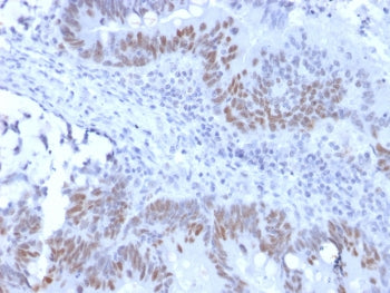 IHC testing of recombinant RB1 antibody and FFPE human colon carcinoma (clone RB1/2313R). Required H