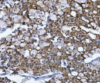 IHC staining of FFPE human liver cancer tissue with NUMB antibody. HIER: boil tissue sections in pH8