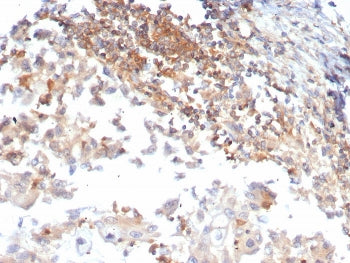 IHC staining of FFPE human ovarian carcinoma tissue with Luteinizing Hormone Receptor antibody (clon