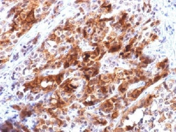 IHC testing of FFPE human hepatocellular carcinoma with recombinant GPC3 antibody (clone rGPC3/863).