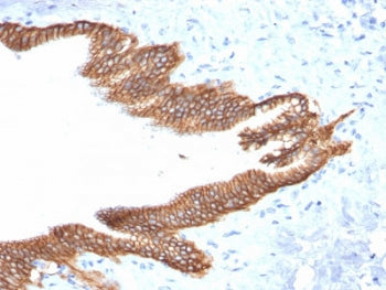 IHC testing of FFPE human pancreatic carcinoma with TROP2 antibody (clone TACSTD2/2152). Required HI