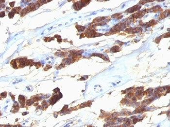 IHC: Formalin-fixed, paraffin-embedded human thyroid carcinoma stained with anti-Thyroglobulin antib