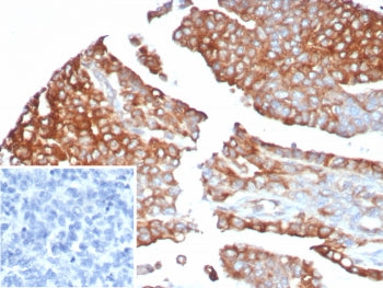 IHC staining of FFPE human ovarian cancer tissue with MX1 antibody (clone MX1/7527). Inset: PBS used