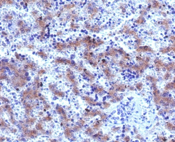 IHC staining of FFPE human hepatocellular carcinoma with Glypican-3 antibody (clone SGPN3-2R). Requi