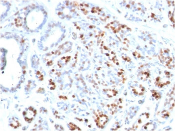 IHC staining of FFPE human breast carcinoma with GATA3 antibody. HIER: boil tissue sections in pH 9 