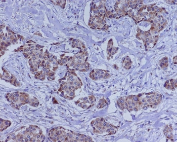IHC staining of FFPE human breast cancer with BMP4 antibody. HIER: boil tissue sections in pH6, 10mM