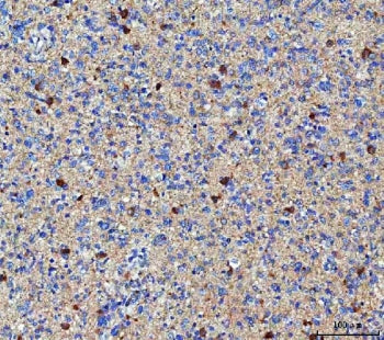 IHC staining of FFPE human glioma tissue with MGAT4B antibody. HIER: boil tissue sections in pH8 EDT