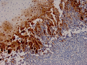 IHC staining of FFPE human esophageal carcinoma tissue with recombinant HSV1 antibody (clone HSV1/40