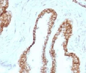 IHC staining of FFPE human prostate carcinoma with CK5 antibody (clone CTKN5-1). HIER: boil tissue s