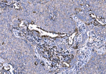 IHC staining of FFPE human lung cancer tissue with 5HT1A Receptor antibody. HIER: boil tissue sectio