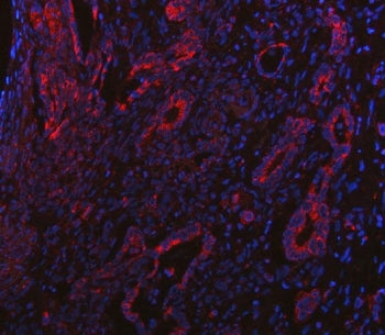 Immunofluorescent staining of FFPE human intestinal cancer tissue with PP18 antibody (red) and DAPI 