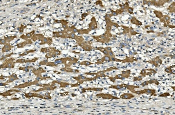 IHC staining of FFPE human liver cancer with CYP2C19 antibody. HIER: boil tissue sections in pH8 EDT