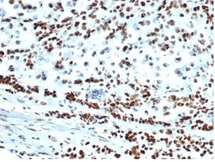 IHC staining of FFPE human colon carcinoma tissue with recombinant MSH6 antibody (clone MSH6/6654R).
