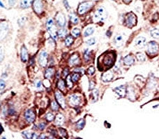 IHC analysis of FFPE human cancer tissue stained with the AXL antibody