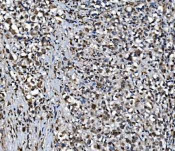 IHC staining of FFPE human gastric cancer with CDC27 antibody. HIER: boil tissue sections in pH8 EDT