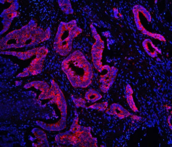 Immunofluorescent staining of FFPE human intestinal cancer with TDRD3 antibody (red) at 1ug/ml and D