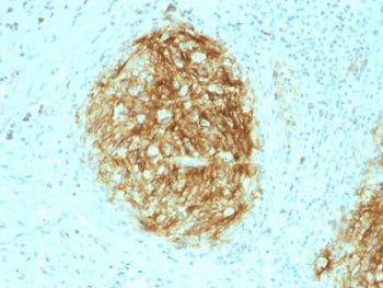 IHC testing of FFPE human follicular dendritic cell sarcoma with CD21 antibody (clone CR2/1953). HIE
